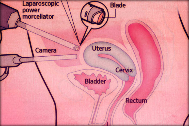 Abnormal bleeding generate uterine cancer