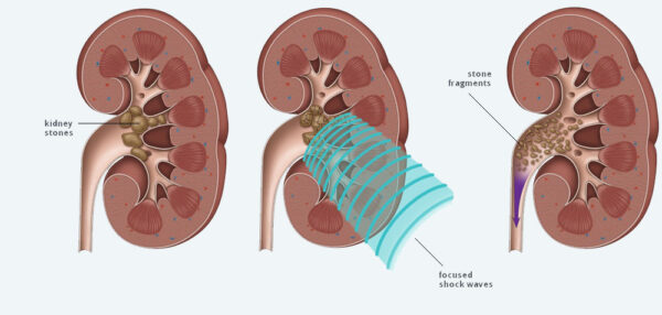 Treatment for Kidney Stone