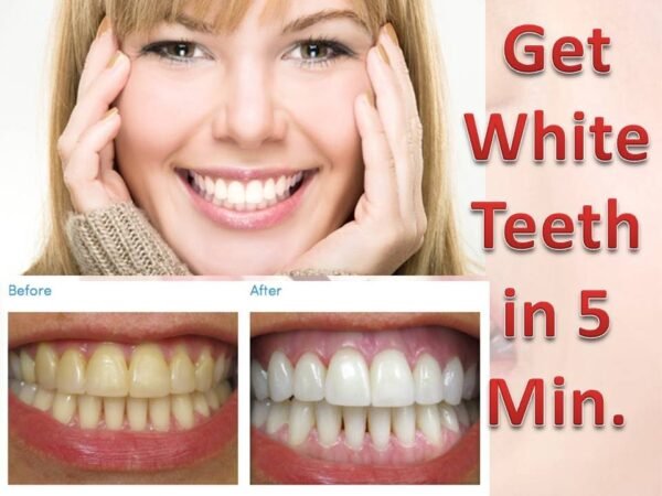 Cheaper Laser Teeth Whitening