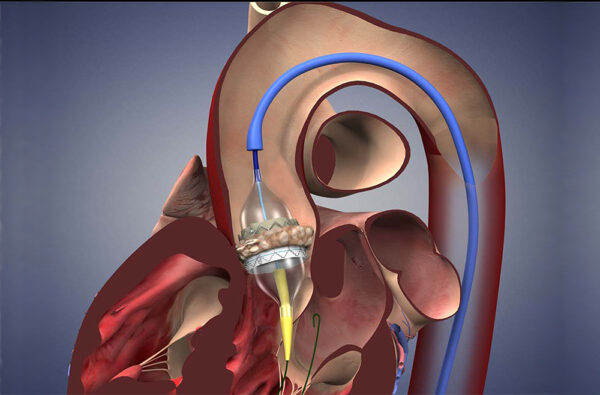 Aortic Valve Replacement