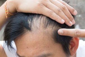 Medications Can Cause Hair Loss