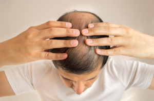 Things No One Tells You About Alopecia