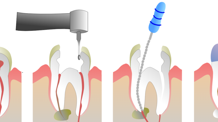 Dentist For a Root Canal